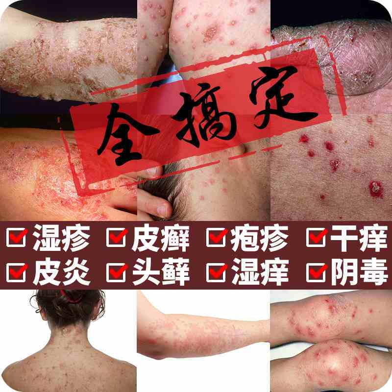 百峰草湿毒王乳膏藏药膏苗药湿毒清御夫王中药皮炎湿疹皮肤瘙痒外用